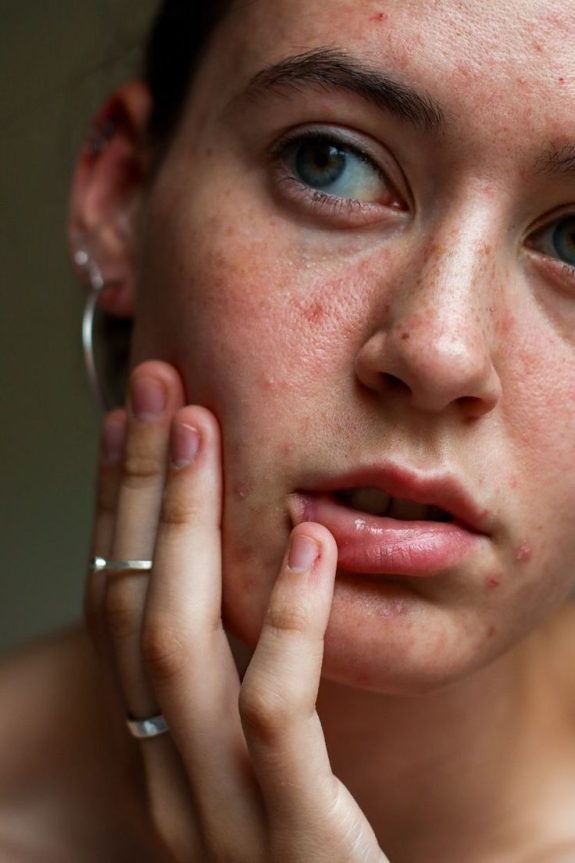 Facial Anti Acné